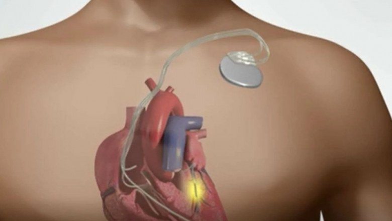 A growing geriatric population and advances in technology will drive the growth of the Implantable Cardiac Pacemaker Market