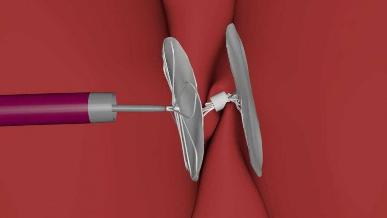 Vascular Closure Device Typically Consist Of A Collar That Is Positioned Around The Puncture Site, Which Is Attached To A Plug Or Occlusive Material