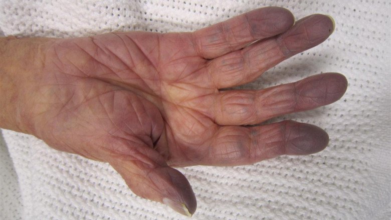 Lidocaine Ointment Market Modern Trends, Top Regions and Latest Entries Forecast 2030
