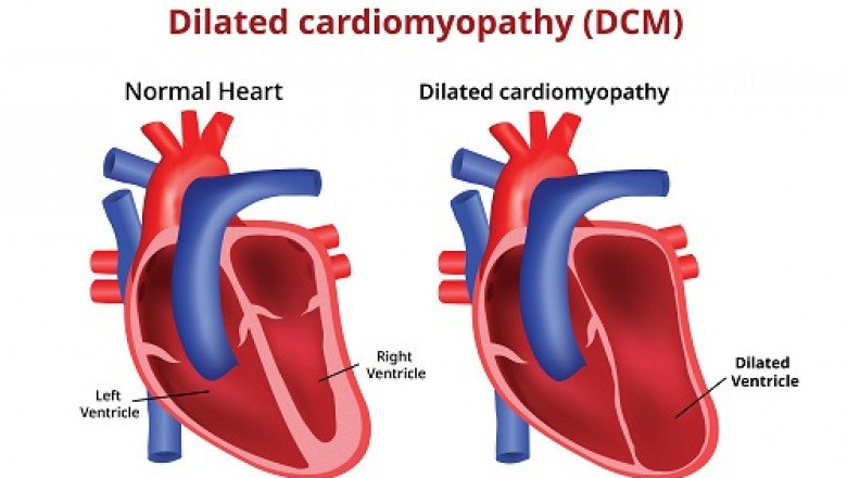 Dilated Cardiomyopathy Market : Global Industry Trends, Share, Size, Growth, Opportunity and Forecast 2022-2028