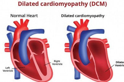Dilated Cardiomyopathy Market : Global Industry Trends, Share, Size, Growth, Opportunity and Forecast 2022-2028