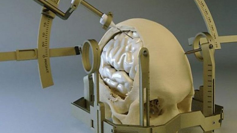 Epilepsy and Parkinson's disease will boost the growth of the Stereotactic Systems Market