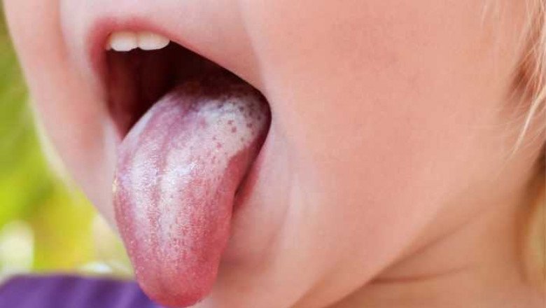 It Is Possible For Candidiasis To Infect The Bloodstream Or Internal Organs, Such As The Liver Or Spleen