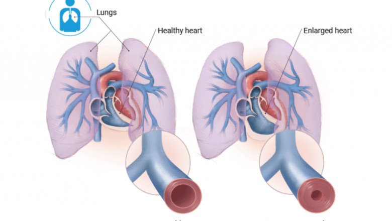 Pulmonary Arterial Hypertension Drugs Used To Treat Pulmonary Arterial Hypertension Can Be Divided Into Several Categories According To Their Mechanism Of Action