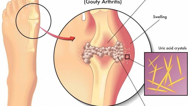 The Deposition Of Uric Acid Crystals In The Joints Causes Gouty Arthritis