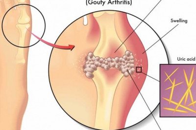 The Deposition Of Uric Acid Crystals In The Joints Causes Gouty Arthritis