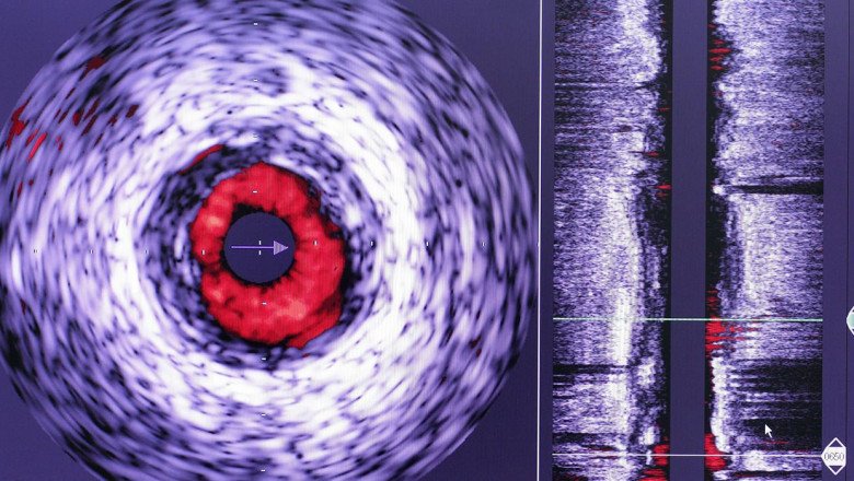 High-Resolution Images Of The Arterial Wall And Plaque Morphology Can Be Obtained Using Intravascular Ultrasound Imaging System In Interventional Cardiology