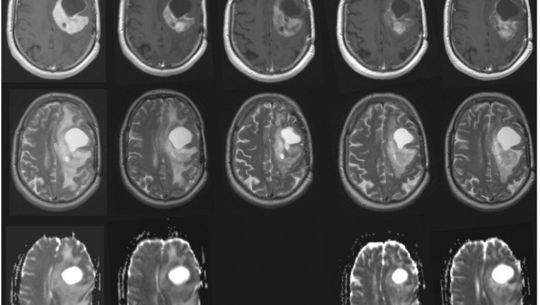 Recurrent Glioblastoma Multiforme Treatment Is A Treatment For Recurrent Glioblastoma That Differs Slightly From Those Used To Treat An Initial Tumour