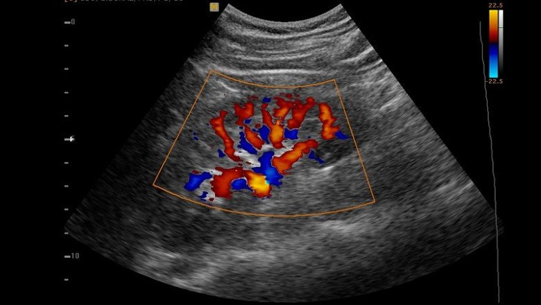 A Doppler Ultrasound Can Be Used To Assess Blood Flow In An Area