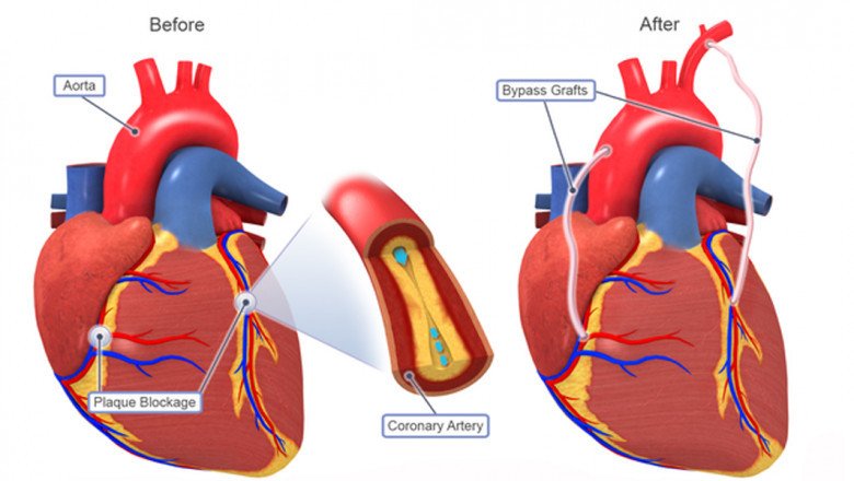Blood Clots, Strokes, Heart Failure, And Other Heart-Related Complication Can Occur Due To Atrial Fibrillation, A Quivering Or Irregular Heartbeat