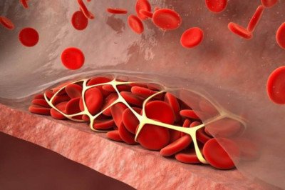 When A Blood Clot Forms In A Vein, It Is Referred To As Venous Thromboembolism (VTE)