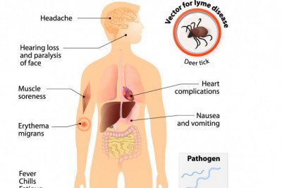 Lyme Disease Treatment Market Size, Status, Top Emerging Trends, Growth and Business Opportunities 2028