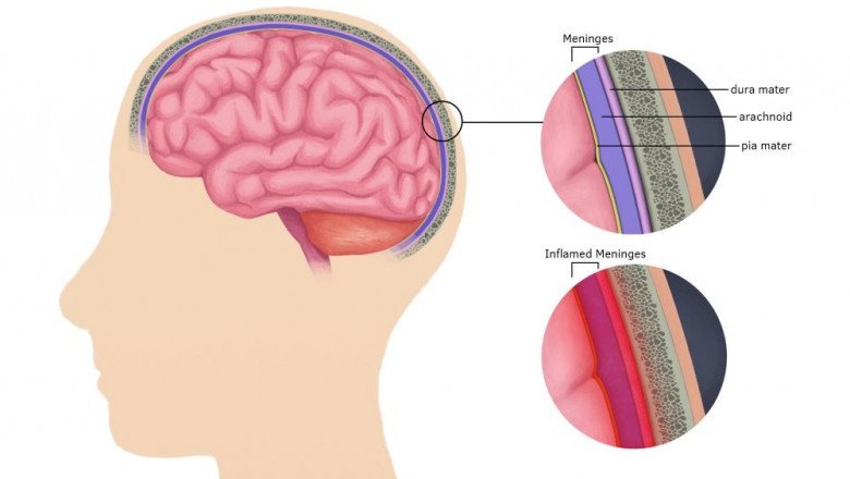 Meningitis Treatment Market Regional Outlook and Forecast Analysis up to 2028