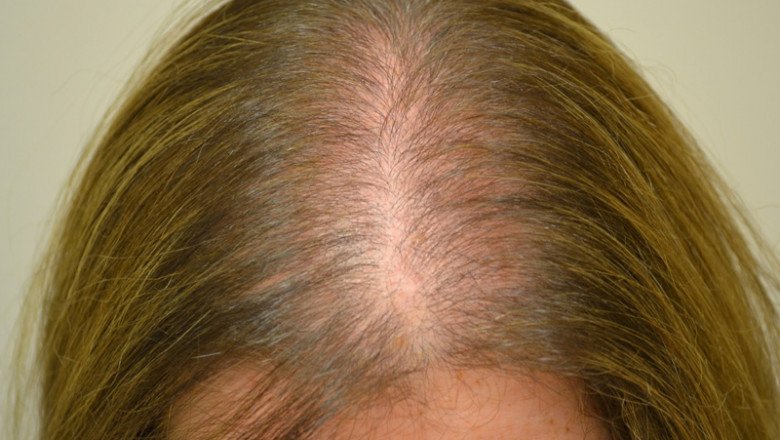 Alopecia Treatment Market Observes a Tremendous Rise in CAGR of 5.3% during the Forecast Period 2021-2028