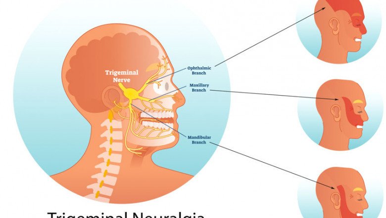Trigeminal Neuralgia Treatment Market Proliferating Opportunities, New Innovation, Development, Application Till 2028
