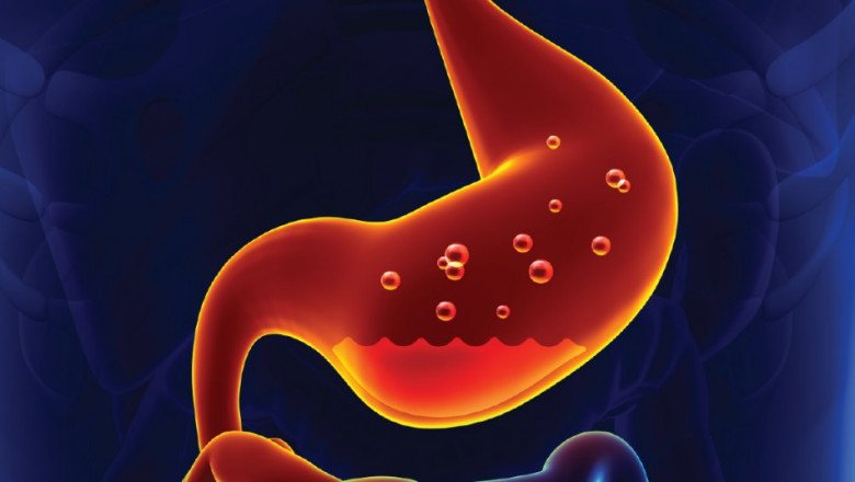 The Gastritis Treatment You Choose Will Depend On Your Condition's Severity, The Underlying Cause, And The Underlying Cause