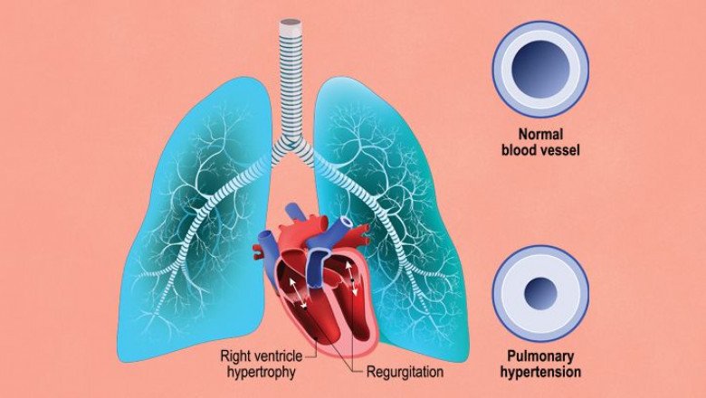 Pulmonary Arterial Hypertension Drug Support Expand Signs And Symptoms As Well As Slow Disease Progression