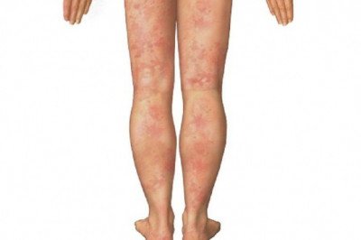 The Basic Goals Of Vasculitis Treatment Are To Reduce Inflammation And Address Any Underlying Conditions That May Be Causing It