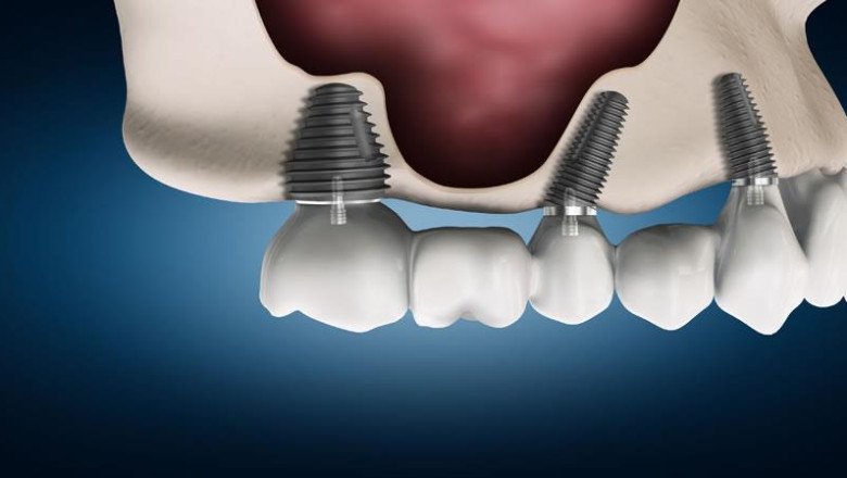 Forecasting 2022-2028: Global Radial Head Resection Implants Market trends, share, size, growth, opportunities, and forecasts