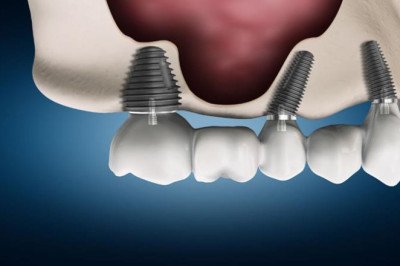 Forecasting 2022-2028: Global Radial Head Resection Implants Market trends, share, size, growth, opportunities, and forecasts