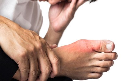Gouty Arthritis Is A Chronic Inflammatory Disease With Debilitating Clinical Symptoms, Functional Impairments, And A Substantial Impact On Quality Of Life