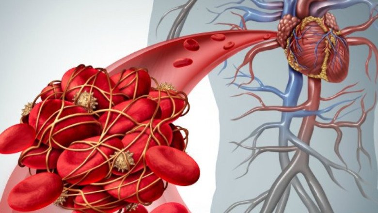 Blood Clots Are Caused By A Condition Called Venous Thromboembolism (VTE), A Serious Medical Condition That Requires Diagnosis, Treatment, And Prevention