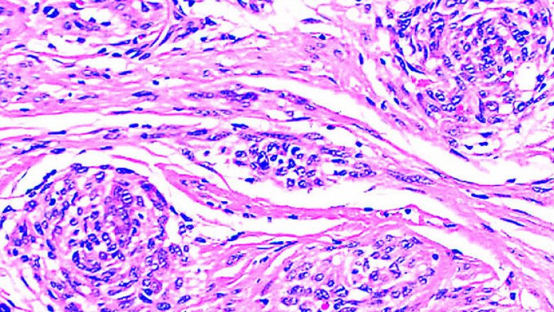 Global Plexiform Neurofibromas Treatment Market : Share, Size, Growth, Opportunity, and Forecast 2022-2028