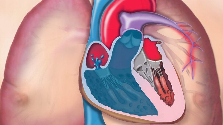 Pulmonary Arterial Hypertension Drug is That Reduce Pulmonary Arterial Hypertension Help Reduce Muscle Contractions In Blood Vessels