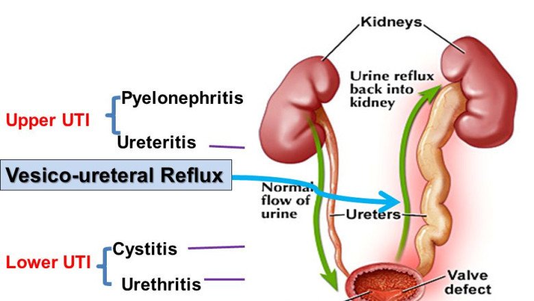 From A Healthcare Cost Perspective, Urinary Tract Infection Treatment Can Be Considered Important