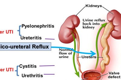 From A Healthcare Cost Perspective, Urinary Tract Infection Treatment Can Be Considered Important
