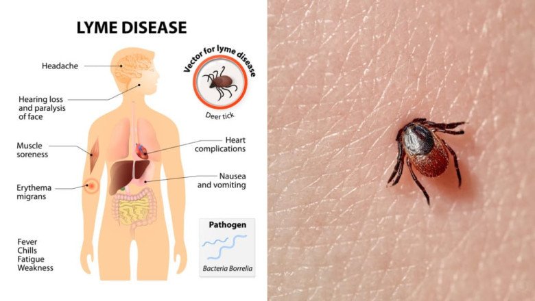 The Lyme Disease Treatment Uses Antibiotics That Can Cure The Disease If It Is Caught Early