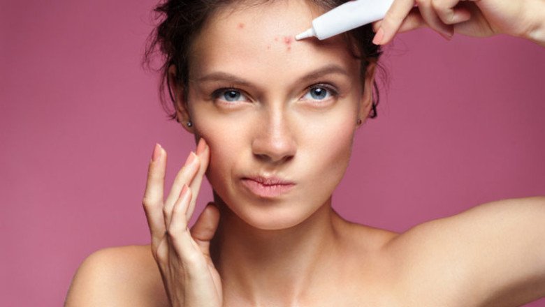 A Common Acne Medication Is Benzoyl Peroxide And Adapalene Used Together