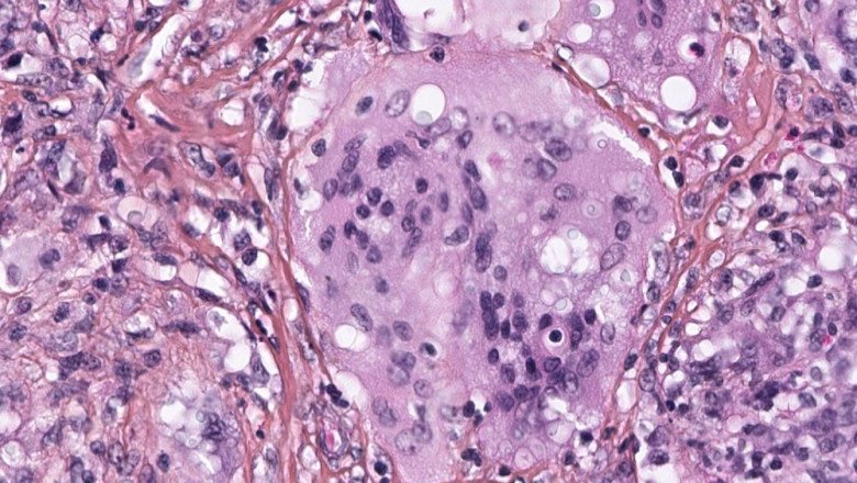 Amphotericin B and Fluconazole can be used in the Cryptococcosis Treatment. They are given intravenously over a long period of time