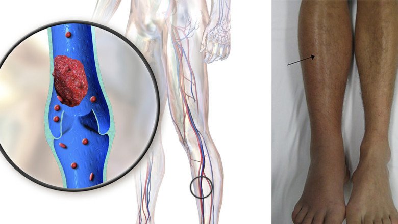 In Venous Thromboembolism (VTE), Blood Clots Block The Flow Of Blood