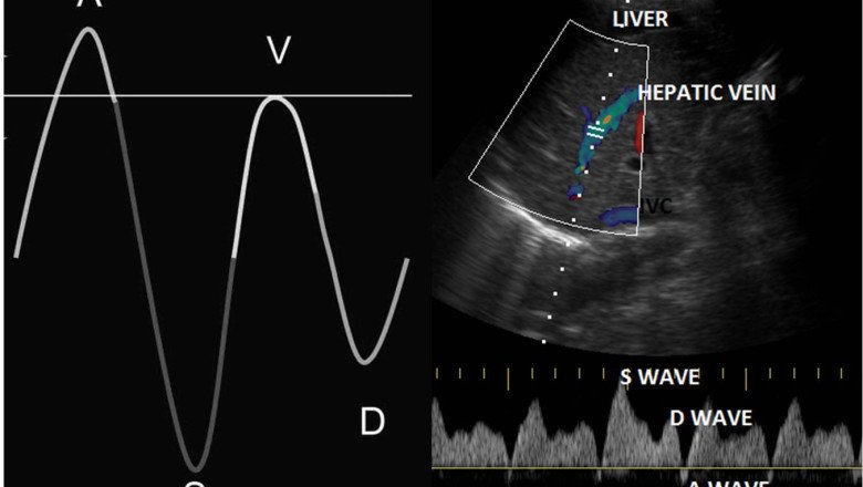 Doppler Ultrasound Market Upcoming Trends, Demand, Regional Analysis and Forecast up to 2028