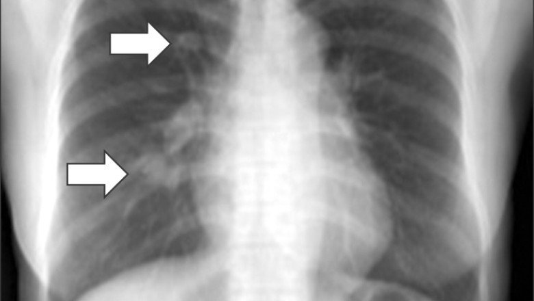 There Is No Place Where A Desmoid Tumors Can't Occur As Your Body Is Made Up Of Connective Tissue