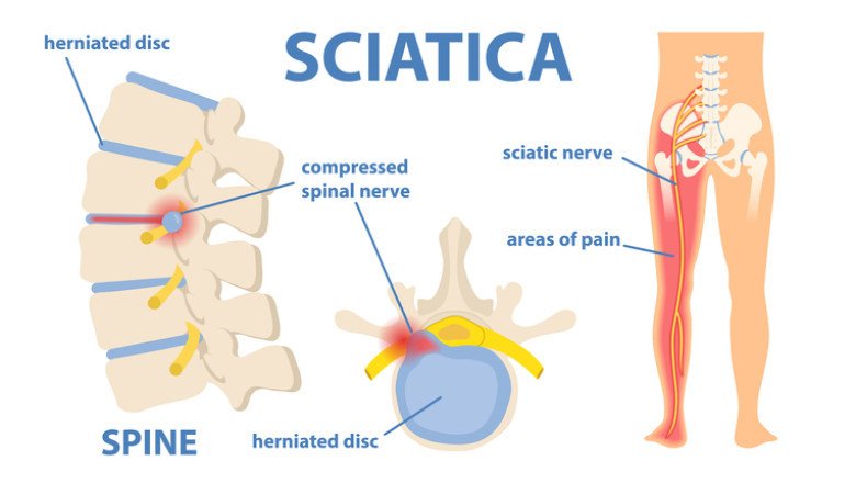 Debilitating Sciatica Is The Result Of Pathology Of The Sciatic Nerve Root Or Sciatic Nerve