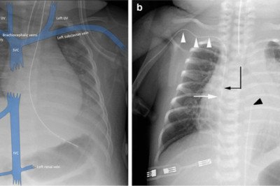 You Receive A Central Venous Catheter (CVC) From Your Healthcare Provider So They Can Insert It Into A Vein In Your Neck, Chest, Arm, Or Groin