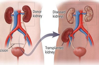 Kidney Transplant Replace A Failing Kidney With A Healthy One, Restoring Kidney Function To The Recipient