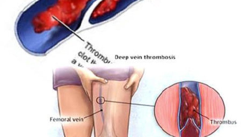 Venous Thromboembolism Can Occur In All Racial And Ethnic Groups, Both Sexes, And All Ages