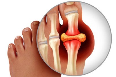 Due To Crystallization Of Uric Acid, Gouty Arthritis Causes Intense Joint Pain