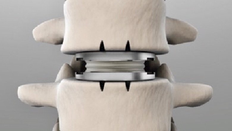 Expert Insights on Lumbar Disc Replacement Device and Its Advantages Over Traditional Surgery