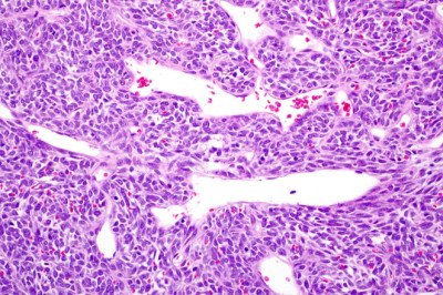 Combining Therapies for Optimal Medical Synovial Sarcoma Treatment Outcomes