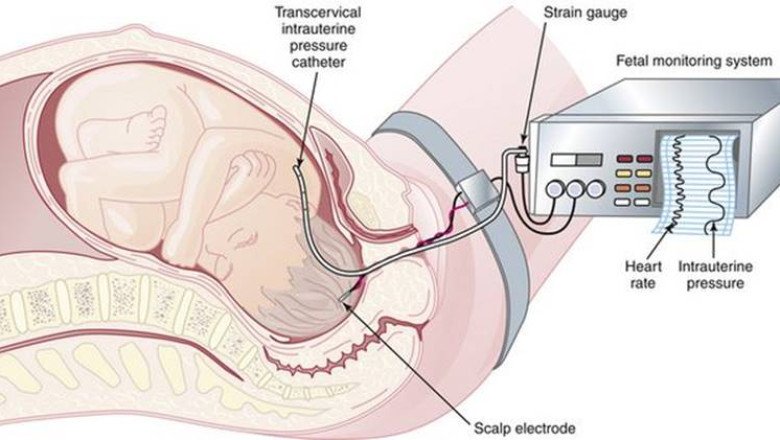 The Role of Artificial Intelligence in Fetal and Neonatal Monitoring