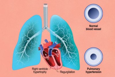 The Lungs Are Also Relaxed By Pulmonary Arterial Hypertension Drugs That Lower Blood Pressure In The Lungs