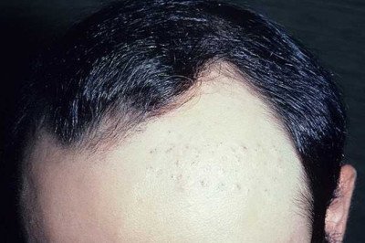 Comparing Different Types of Medications in Androgenetic Alopecia Treatment Market