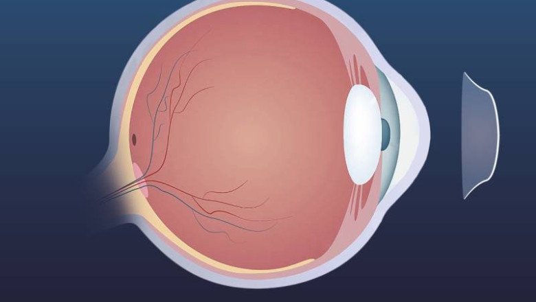 Myopia Is Generally Treated With Orthokeratology