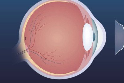 Myopia Is Generally Treated With Orthokeratology