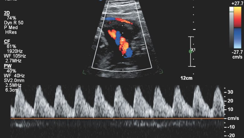 An Doppler Ultrasound Measures The Flow Of Blood In The Body