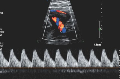 An Doppler Ultrasound Measures The Flow Of Blood In The Body